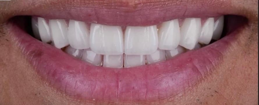 The same smile after treatment — even, bright, natural-looking teeth