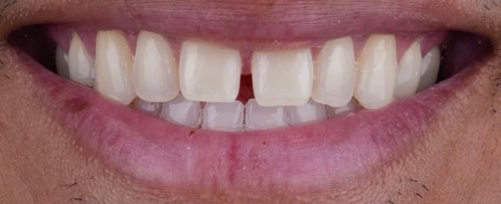Patient's smile before treatment — uneven edges and a gap between the front teeth